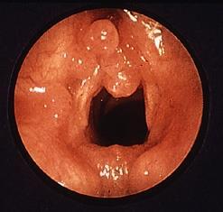Larynx Papillomatose häufigster gutartiger Tumor des