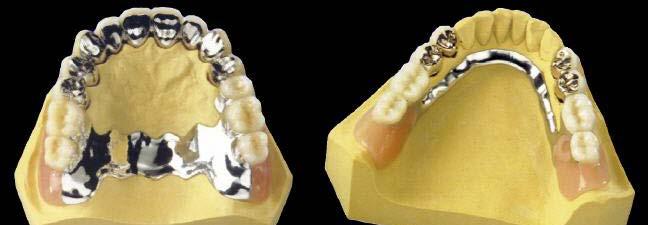Teleskop-Prothese als Modellgussdeckprothese Beschreibung: Statt mit Klammern kann man eine Modellgussprothese auch mit Teleskopen (Doppelkronen) auf den eigenen Zähnen oder Implantaten befestigen.