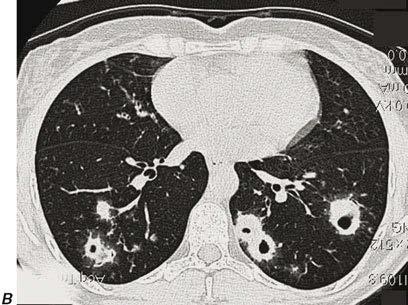 und (B) multiple kavernöse Lungenläsionen zeigen.