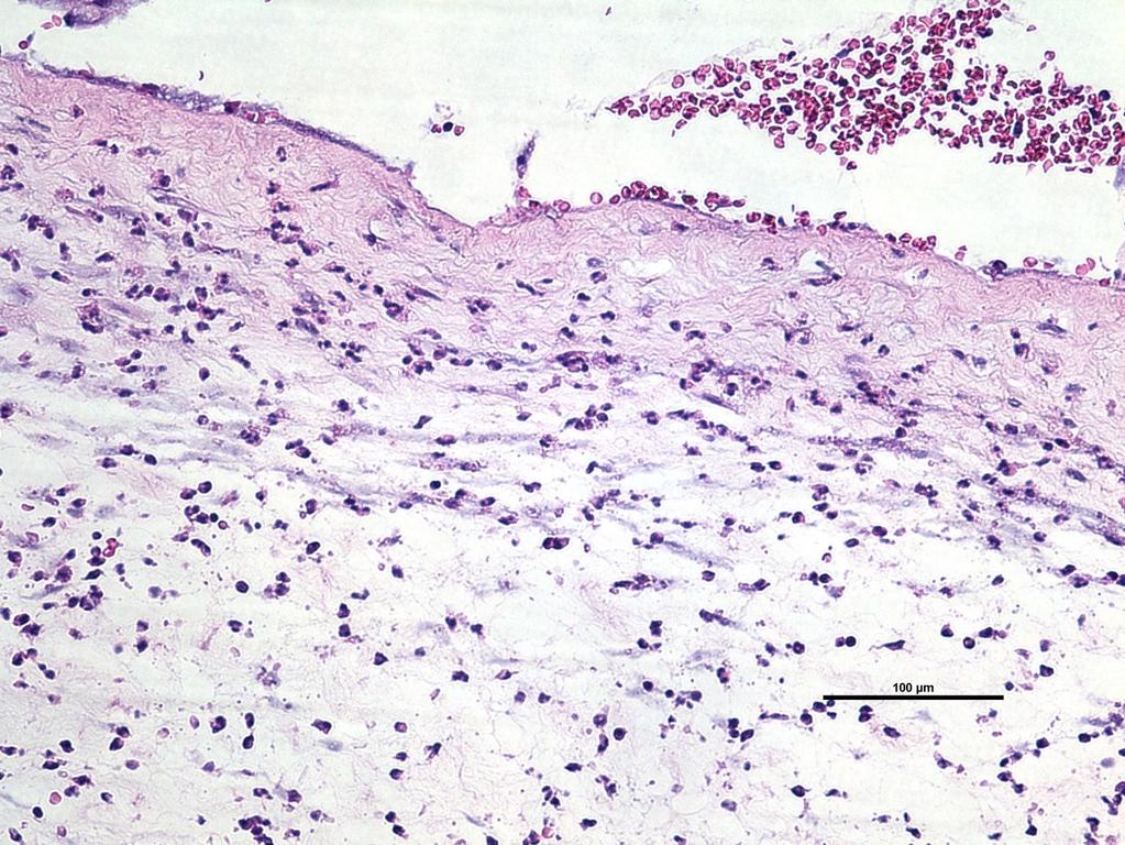 Abbildung 1: Amnioninfektion (zur Verfügung gestellt von DR. Barbara Gürtl- Lackner des Institutes für Pathologie Graz) Innerhalb der Nabelschnur sind zuerst die V.