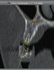 Implantatchirurgie ermöglicht eine präzise Visualisierung der intraoralen Anatomie