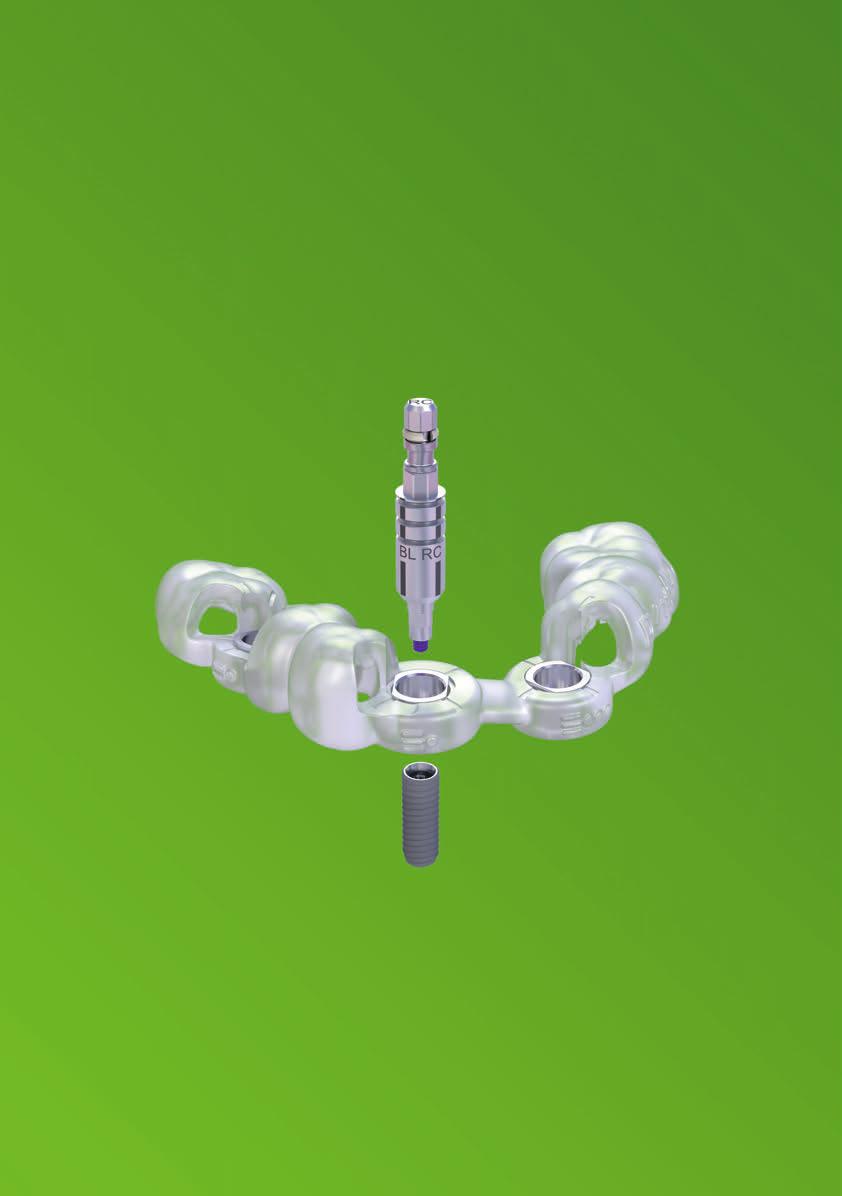 Ausrichtungshilfe für Bone Level Implantate: Die Rotationsmarkierungen an der Bohrschablone und die Markierung am geführten Bone Level Übertragungsteil ermöglichen die Visualisierung der