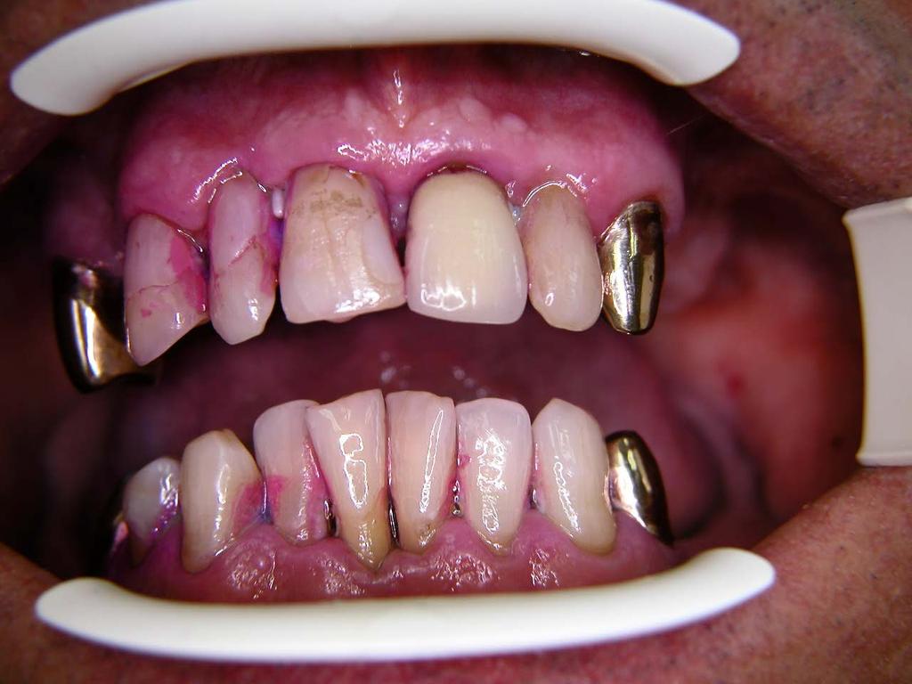 Rückgang des Zahnfleischs, Auflösung der
