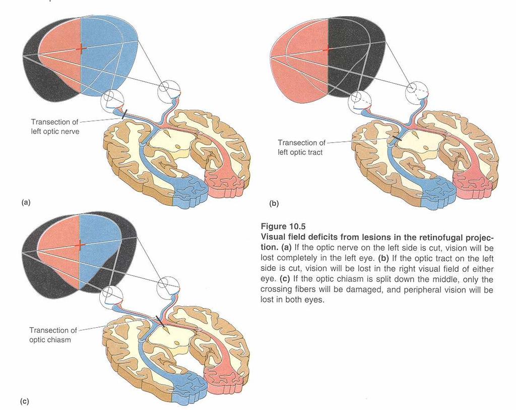 Defizite bei Läsionen Linker Nervus opticus Linker Tractus opticus Chiasma opticum 1. Linker Nervus opticus: Sehverlust im linken Auge 2.