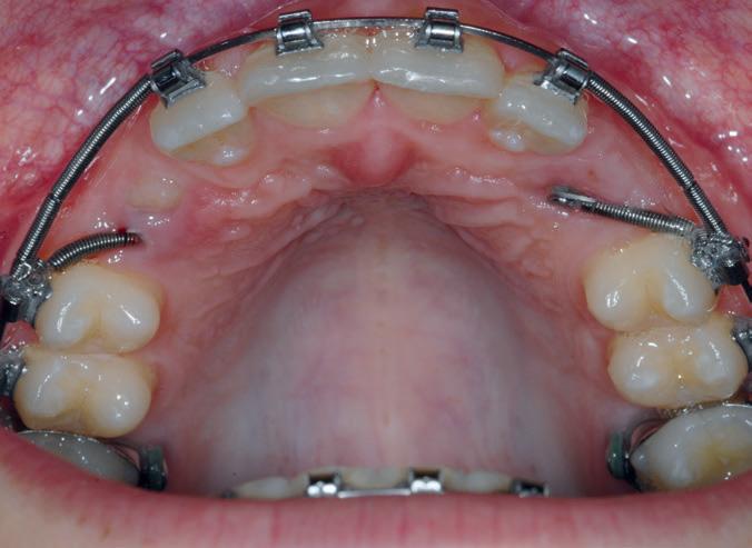 56 BZB Mai 18 Wissenschaft und Fortbildung Abb. 7: Klinische Situation während der Einstellung der Zähne 13 und 23 mit dem EWC-System Abb.