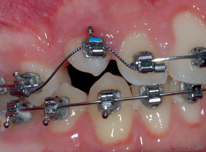 10 und 11: Klinische Situation nach erfolgter Einstellung der Zähne 13 und 23 und Behandlungsabschluss Die Nachaktivierung erfolgte im Abstand von vier Wochen durch weitere Kürzung der Zugfeder um