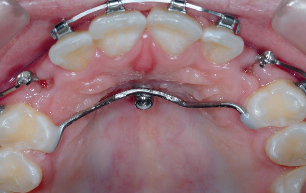 58 BZB Mai 18 Wissenschaft und Fortbildung Abb. 15: Klinische Situation mit der skelettalen Verankerung an den Zähnen 14 und 24 Abb.