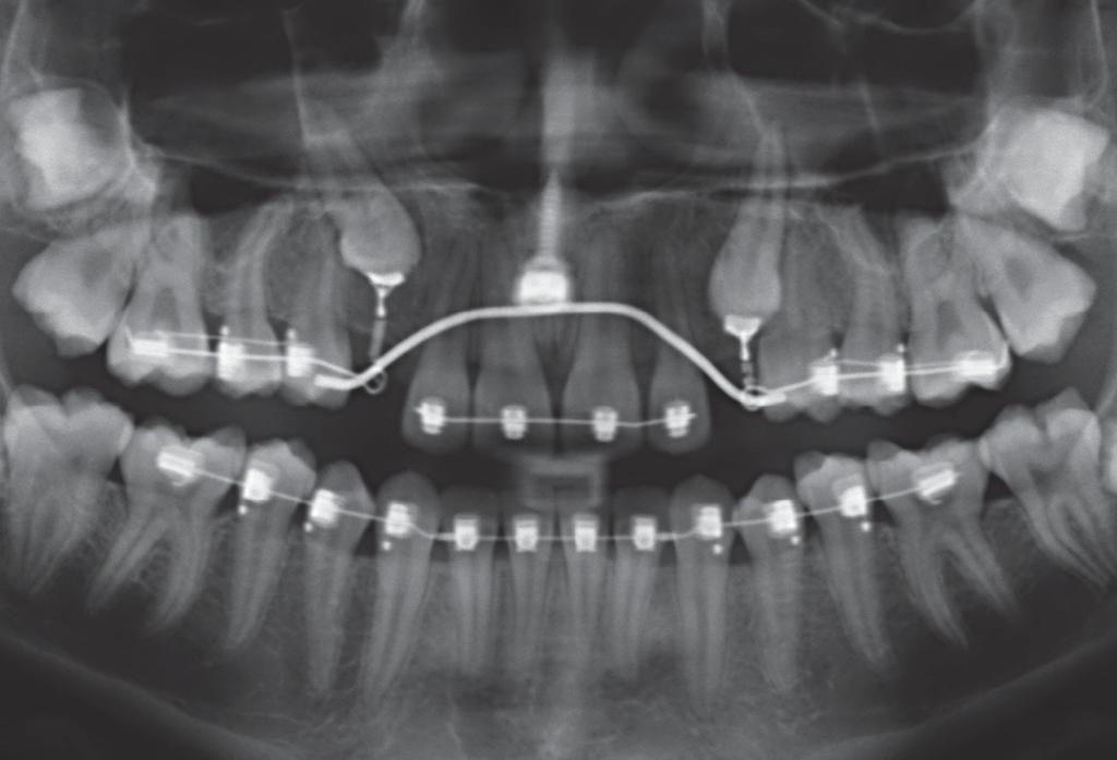 19: Klinische Situation während des Finishings der Einstellung des Zahnes 23 27,1 Monate nach Freilegung hatte der Zahn 23 seine vertikale Position erreicht.