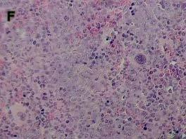 Typisch für das Glioblastom sind die dichten astrozytär differenzierten Zellen mit aufgeblähtem Zytoplasma. Die Zellkerne erscheinen chromatinreich und polymorph.