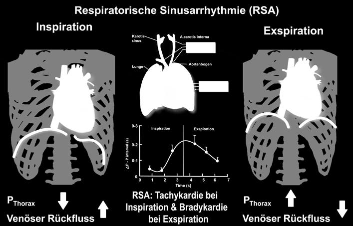 Aufgrund einer inspiratorischen vagalen Inhibition ergeben sich Fluktuationen der Herzfrequenz mit derselben Frequenz wie die Atmung.