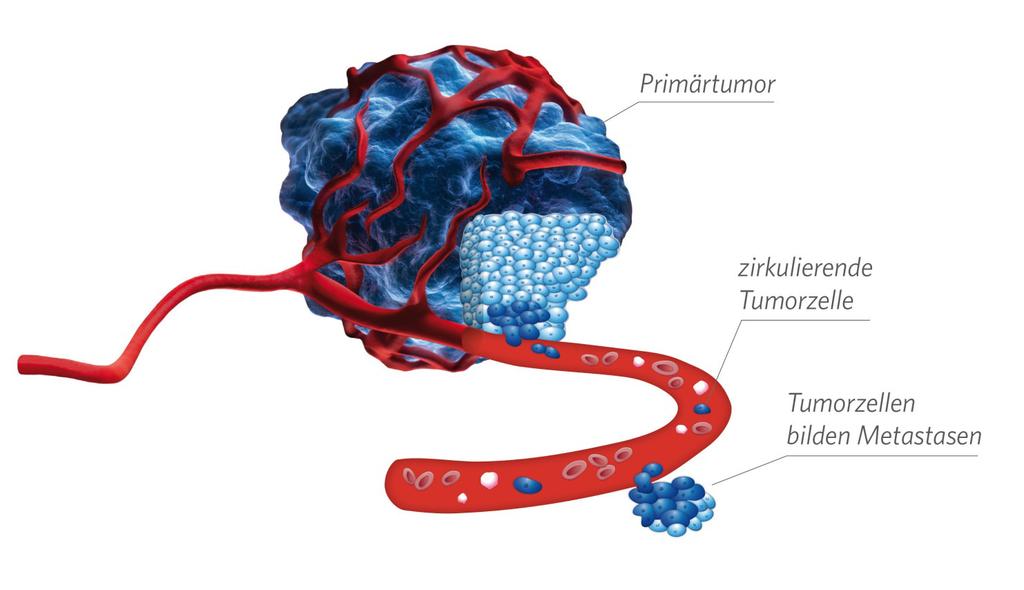 Metastasenbildung durch zirkulierende Tumorzellen!