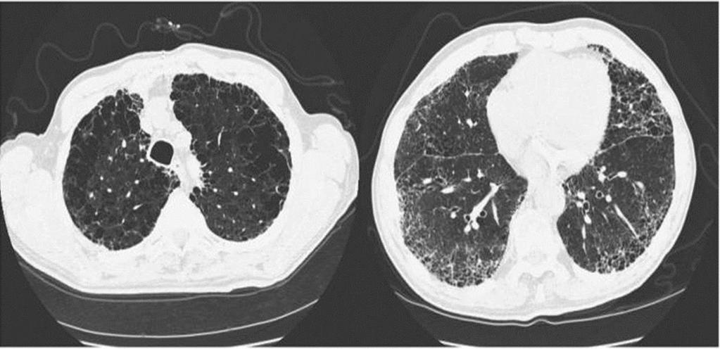 PH bei Lungenerkrankungen Unverhältnismässig schwere Störung Gasaustausch/Dyspnoe -> Echokardiographie out of