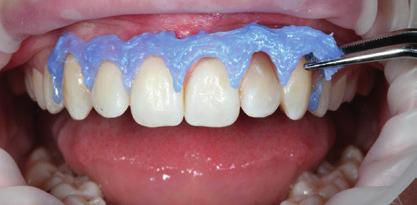 Zahnfleischschutz während des Bleichens Darüber hinaus werden die prismenartigen Strukturen des Zahnschmelzes aufgeraut und auch angelöst, was die Lichtleitung aus der Tiefe des Zahninneren heraus