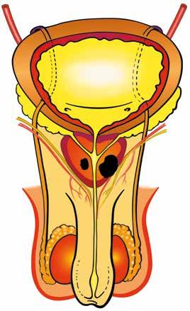 Gefäß-Nerven- Bündel Prostatakarzinom im Randbereich der Prostata