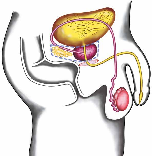 ZUSTAND VOR DER OPERATION Blase Blasenhals Samenleiter Samenblasen Prostata äußerer Schließmuskel Enddarm