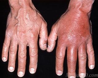 Phlegmone - Cellulitis Rot