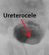 extravesikalen Ureterocelen kommt es oft zu keiner schattenbildenden Raumforderung am Blasenhals, da die Kontrastmittelanreicherung nicht ausreichend vorhanden ist (15).