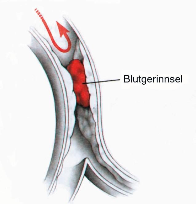 Herzinfarkt Definition Herzinfarkt bedeutet Tod von