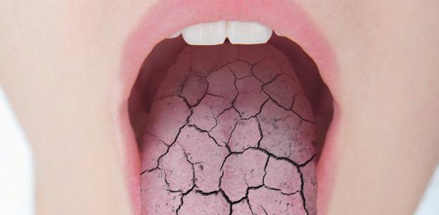3 Mundtrockenheit kann die Lebensqualität erheblich einschränken und das Risiko für viele Erkrankungen im Mund erhöhen Die stimulierte Speichelfließrate, z. B.