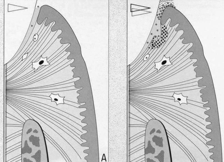 Entwicklung der Gingivitis und Parodontitis nach Rateitschak Polymorphkernige