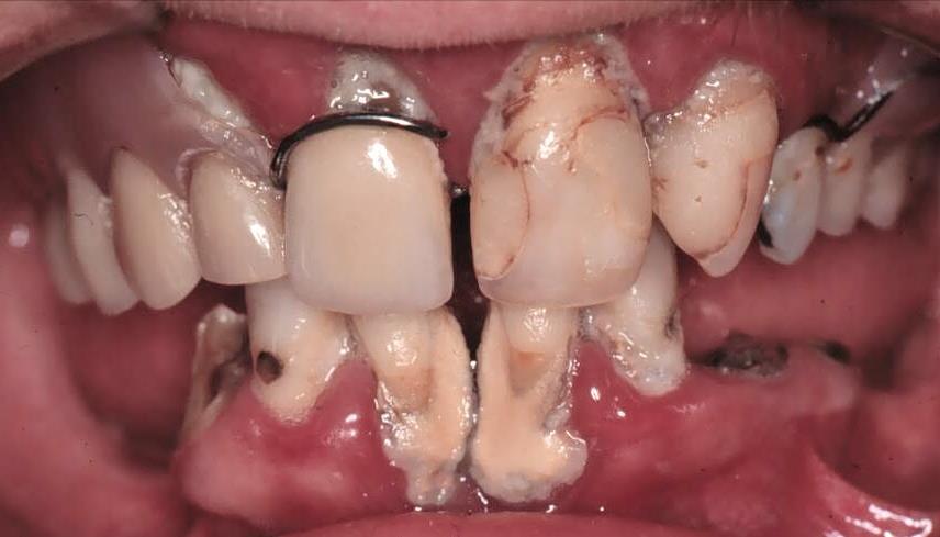 Unspezifische Plaquehypothese Zunahme der allgemeinen Plaquemenge führt per se zur Parodontitis.