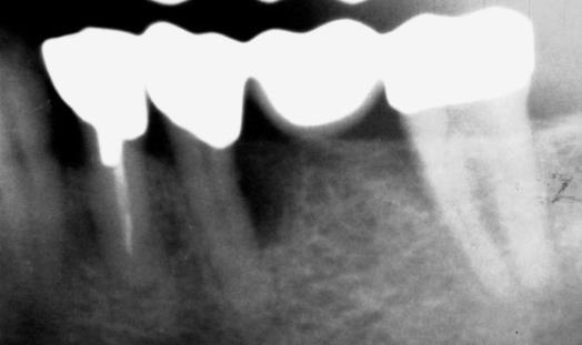 An Zähnen mit progressiver Parodontitis kann okklusales Trauma als Kofaktor für das Fortschreiten des destruktiven Prozesses fungieren.