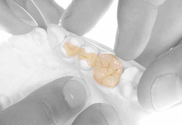 Im vorliegenden klinischen Fall sollte der Zahn 11 metallkeramisch versorgt werden Aestethics Now!