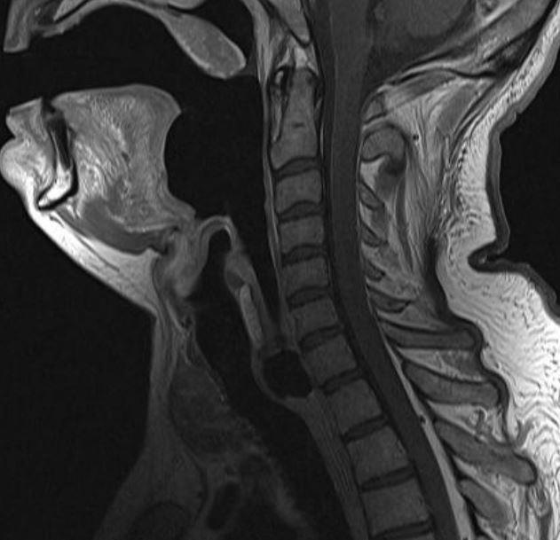 Abbildung 15: MRT Hals im Sagittalschnitt und T1-gewichtet. Links: ilts-d mit umgeschlagener Epiglottis. Rechts: ilts-d etwas zurückgezogen.