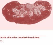 018 Tubulointerstitielle Nephritis, nicht als akut oder N12 chronisch bezeichnet L63F 0,582 2.018 130 Noch fehlende tubulointerstitielle u. tubuläre Krankheiten ICD Text DRG BWR Erlös N14.