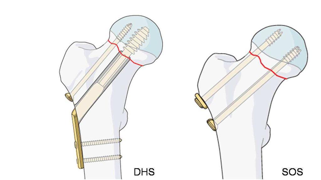 Für die kopferhaltene Therapie stehen verschiedene Implantate zur Verfügung.