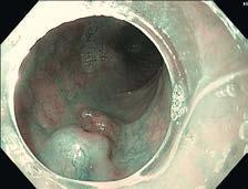 Titelthema Abb. 2: Endoskopische Submukosadissektion eines mukosalen Plattenepithelkarzinoms.