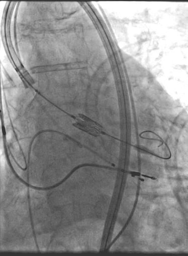 Schwerpunktthema 2018: Valvular Heart Disease 2017: 40 Years of Percutaneous