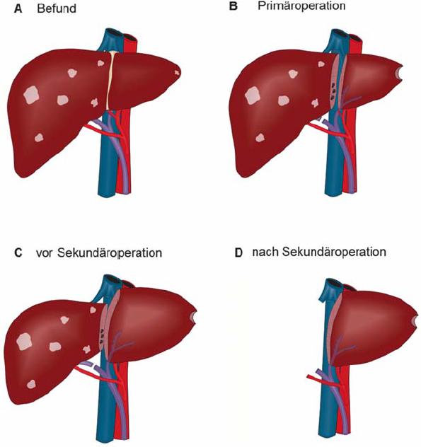 In situ liver split/ Associating Liver Partition and Portal vein