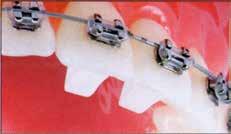öffnet Tiefbisse mit schnellen Ergebnissen werden lingual auf die OberkieferFrontzähne geklebt vermeidet okklusale Störungen komfortabel für den Patienten das Kunststoffmaterial greift den