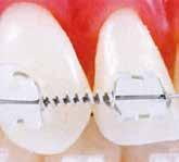 Der Bogen bietet geringe Kraft für den Patientenkomfort, reduziert unnötigen Zahndruck und verringert die Möglichkeit des Wurzelabbaus.