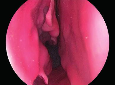 Abb. 5: Einblick in das Cavum nasi rechts, mit Strukturen der lateralen Nasenwand: Septum nasi, Concha nasalis inferior, Concha nasalis media, Choane (0 -Optik). Abb.