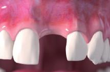 schönen ästhetischen Erscheinungsbild bei. Wie kann Zahnfleisch wiederhergestellt werden?