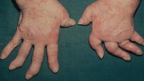 Sakroileitis Wann denkt man an eine reaktive Arthritis?