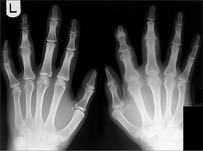 Röntgen: "Para-ossäre Ossifikationen" Bildgebende