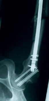 Bei bis zur Hälfte der Patienten wurde eine Verletzung des ipsilateralen Kniegelenks festgestellt.