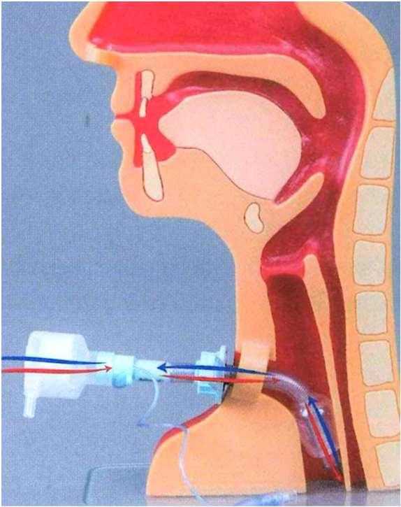 Folgen einer geblockten Trachealkanüle Ein- und Ausatmung auschließlich über Trachealkanüle Kein Luftstrom über Mund/Nase, Rachen und