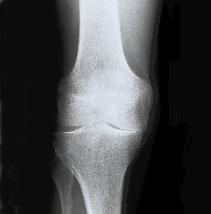Diagnose erkrankter Gelenke Auf dem Röntgenbild ist die Knorpelschicht nicht sichtbar, sie zeichnet sich nur durch die umgebenden Knochenstrukturen als Spalt zwischen den Gelenkanteilen ab.