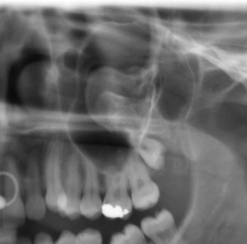 Osteolysen bedingt ist (Schwenzer, et al., 2009)(Abb. 3). Abb. 2: Keratozystischer odontogener Tumor am linken Ramus mandibulae (LKH Graz) Abb.