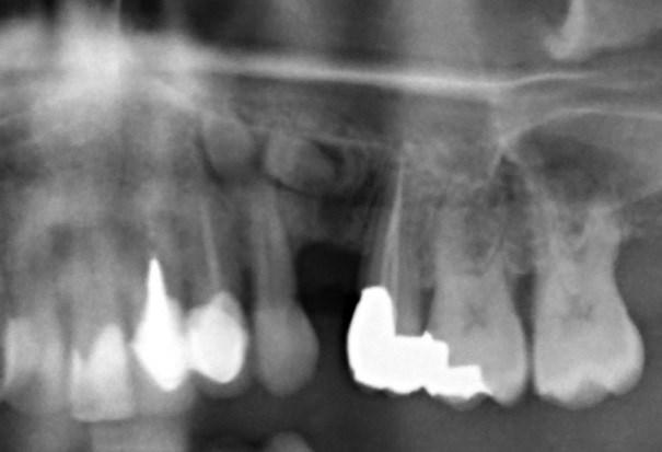 Auch bei diesen odontogenen Tumoren ist oft ein Auftreten an retinierten Zähnen feststellbar. Die Symptome sind auch hier unspezifisch und zeigen als erstes Zeichen meist eine schmerzlose Schwellung.