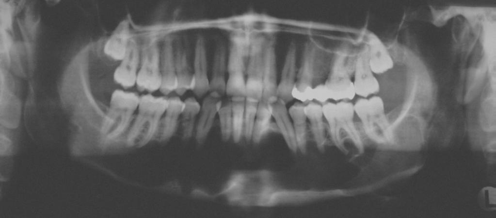 Angrenzende Zähne können Wurzelresorptionen oder Dislokationen aufweisen. Abb. 7: Glanduläre odontogene Zyste (Weiss, et al., 2011