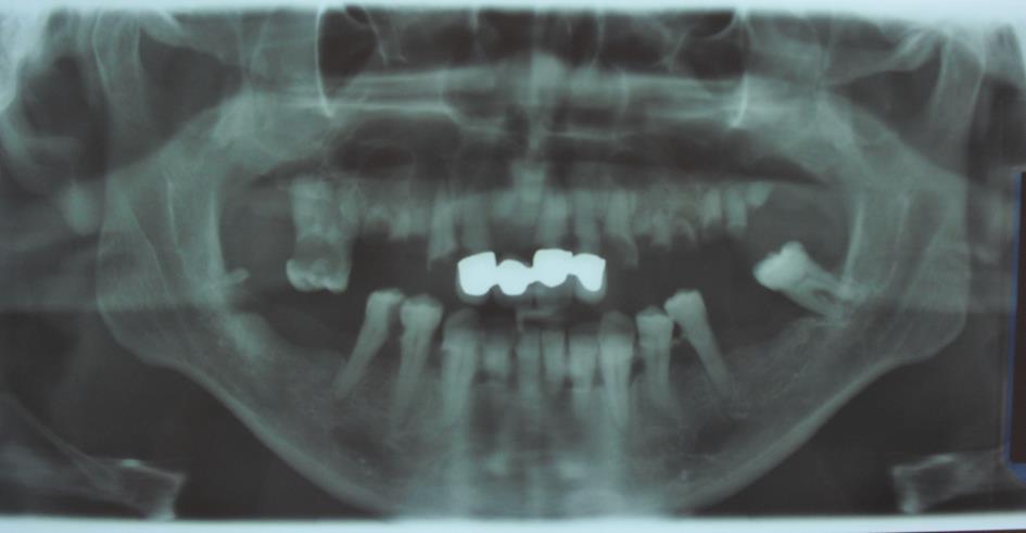 Abbildung 6: Orthopantomogramm mit multiplen radikulären Zysten im rechten und linken Oberkiefer ausgehend von einer Entzündung der Zahnpulpa durch Karies und weitgehender Zerstörung der Zahnkronen 1.