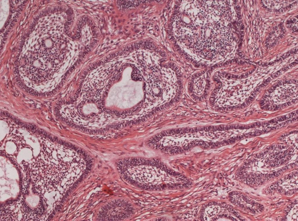 Abbildung 13: Follikuläres multizystisches Ameloblastom, 10fache Vergrößerung Unizystisches Ameloblastom Beim unizystischen Ameloblastom unterscheidet man 4 verschiedene Wachstumsformen.
