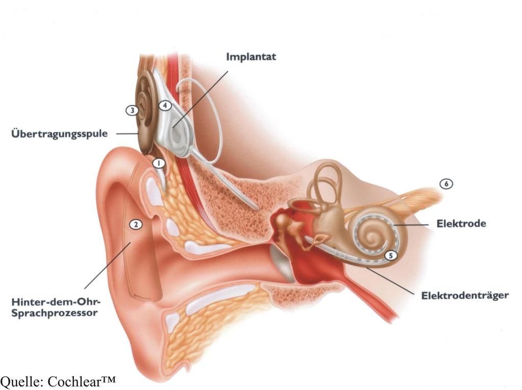 3.Wenn Hörgeräte versagen Cochlea-Implantate 3.