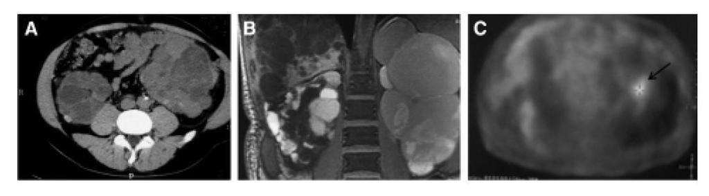 Nierenzysteninfekt links in verschiedenen Bildgebungen CT ohne Kontrastmittel MRI