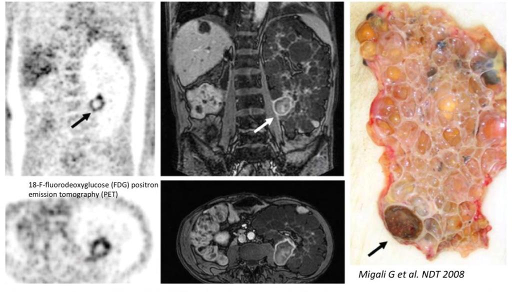 Nierenzysteninfekt im FDG PET und MRI Migali G et al.